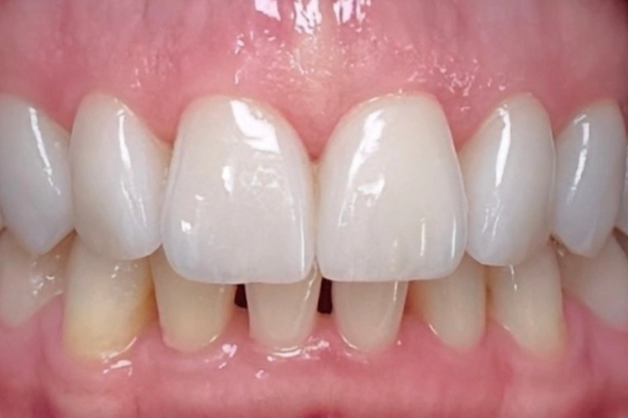 Estetica dentale 1 - dopo