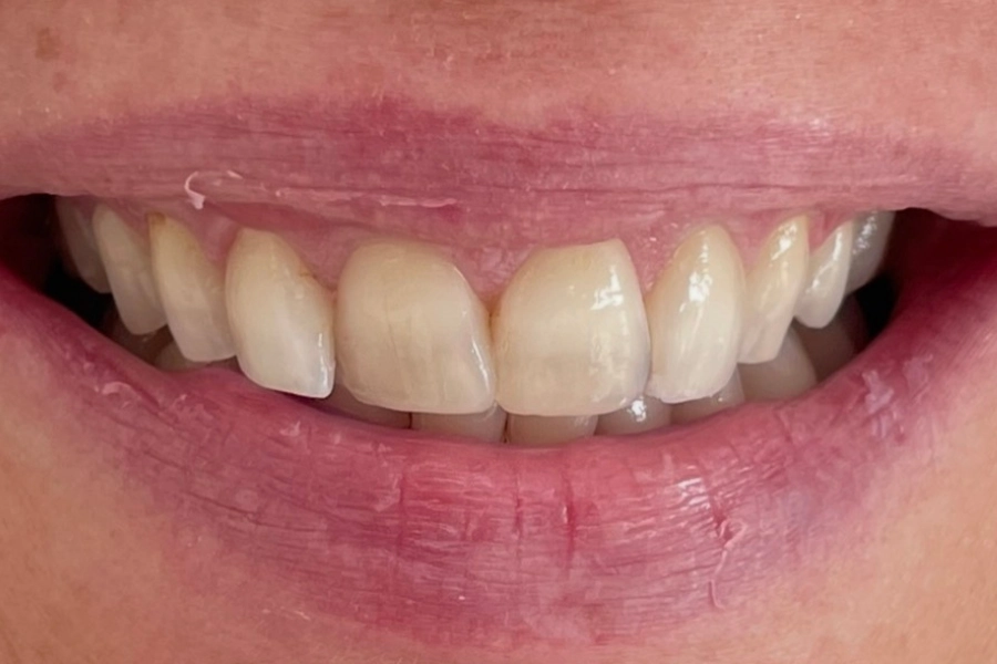 Estetica dentale 2 - prima