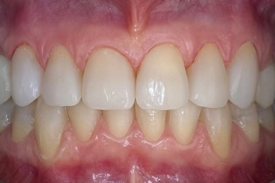 Estetica dentale 3 - dopo